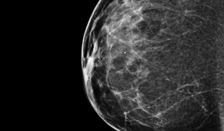 Nanopartículas de óxido de ferro podem ajudar a impedir o avanço do câncer de mama