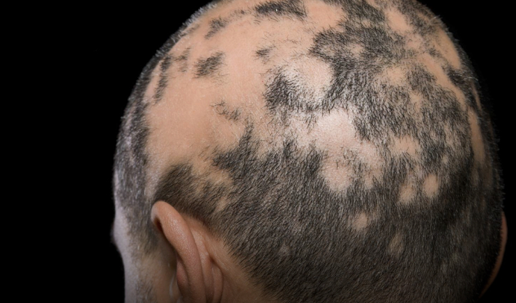 Após estudos internacionais, Anvisa aprova medicamento para tratar alopecia areata grave
