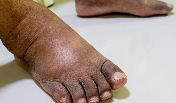 Ozonioterapia avança no Brasil e ganha respaldo inédito da Anvisa para tratamento de feridas complex
