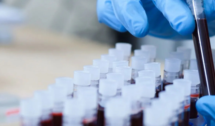 Exame de sangue combinado identifica Alzheimer com 90% de precisão, diz estudo