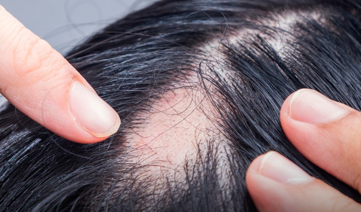 Baricitinibe: Anvisa aprova medicamento contra queda de cabelo e farmacêutica analisa
