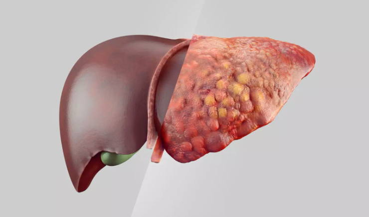Survodutida mostra resultados promissores contra obesidade e gordura no fígado em fase 3