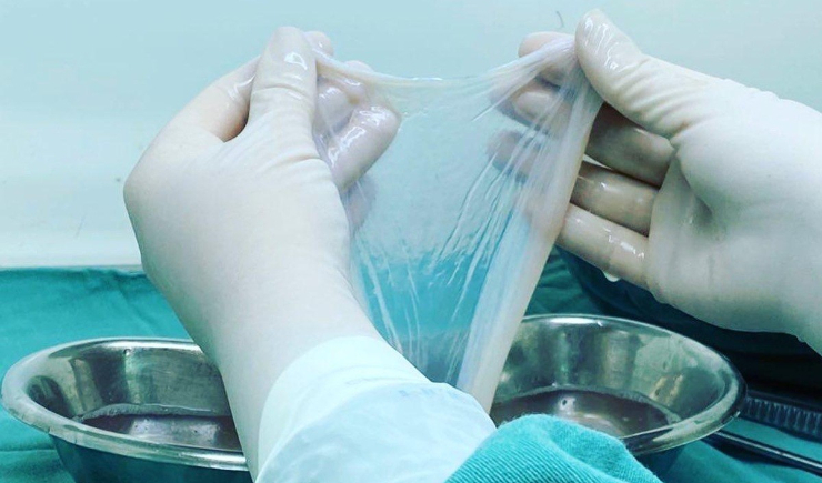 Uso de membrana que envolve o feto no tratamento de queimaduras pode ser incorporado ao SUS