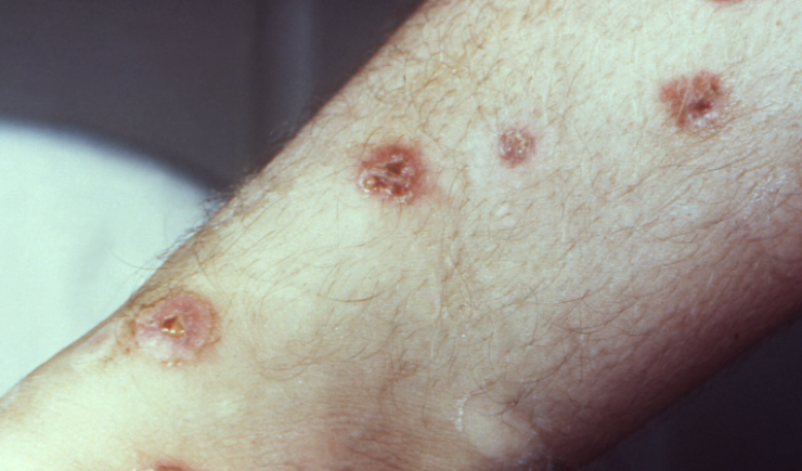 Sífilis avança no Brasil e já é considerada epidemia persistente
