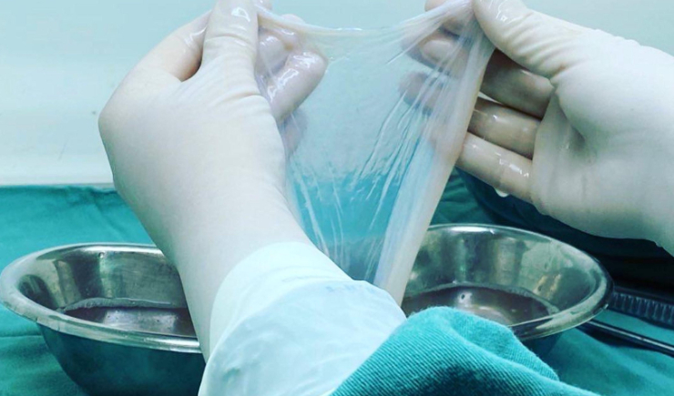 SUS ofertará terapia com transplante da membrana amniótica no tratamento de queimaduras