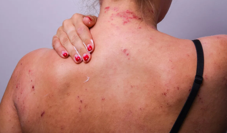Pacientes com dermatite atópica passam a contar com tratamento integral no SUS