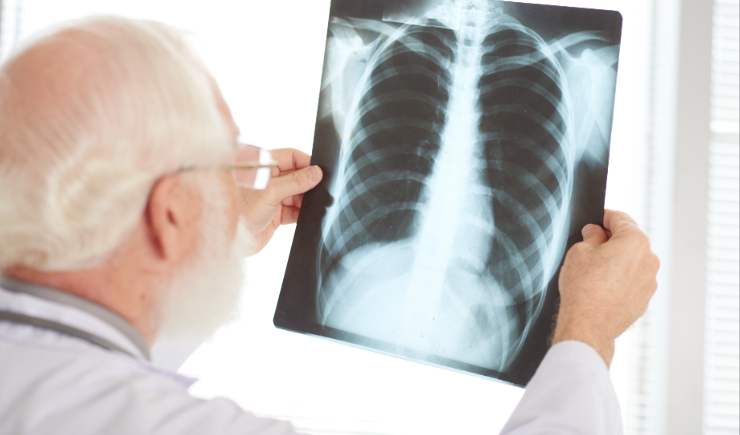 Anvisa aprova medicamento para hipertensão pulmonar associada à doença pulmonar intersticial