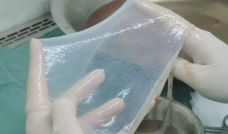 SUS incorpora transplante de membrana amniótica para tratar feridas crônicas e doenças oculares