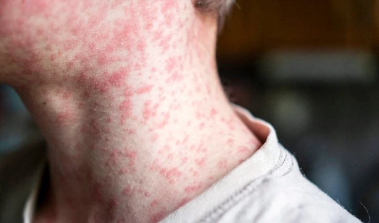 Casos de sarampo disparam nas Américas e Opas alerta para risco de reintrodução da doença