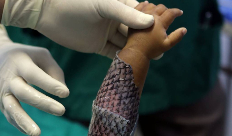 Brasil terá primeira fábrica de pele de tilápia para tratamento de queimaduras