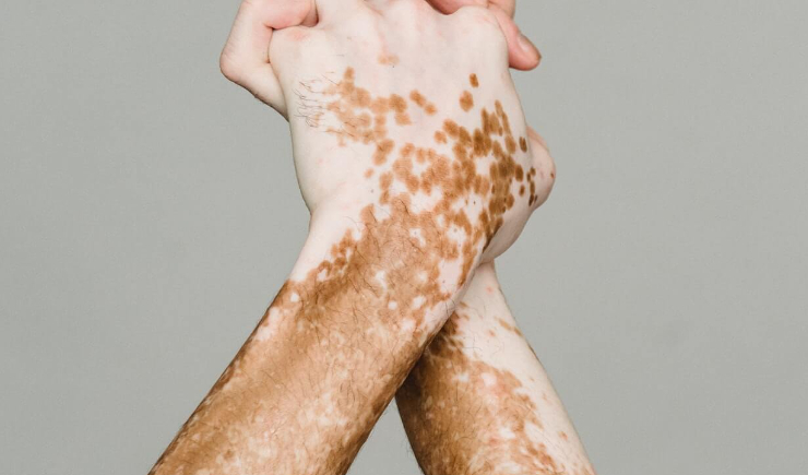 Novas terapias contra o vitiligo abrem caminho para tratamento mais eficaz e duradouro