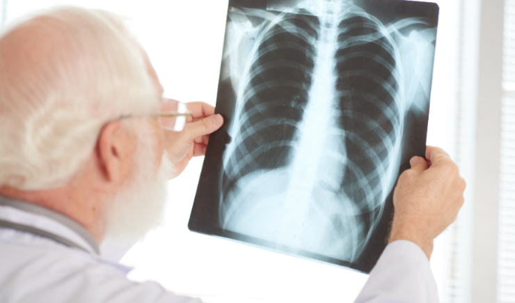 Anvisa aprova medicamento para hipertensão pulmonar associada à doença pulmonar intersticial