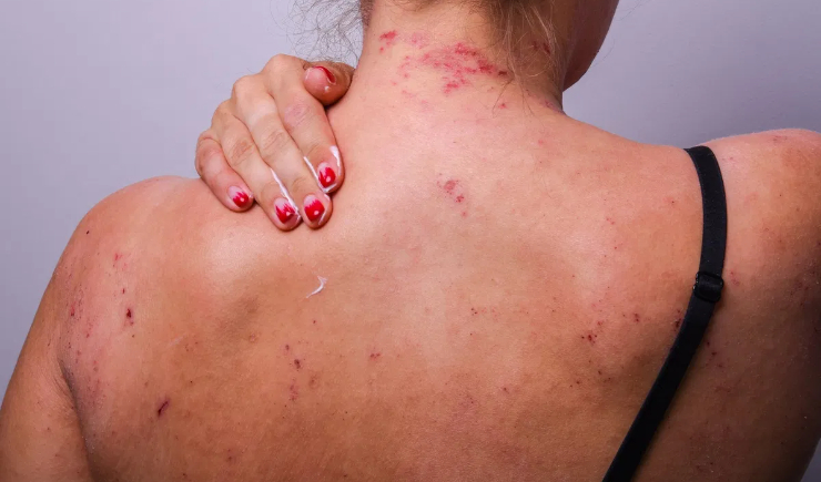 Pacientes com dermatite atópica passam a contar com tratamento integral no SUS
