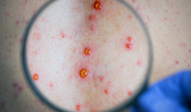 SUS amplia uso da doxiciclina para prevenir sífilis e clamídia após exposição de risco