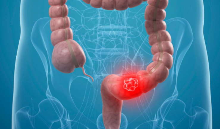 SUS adota novo exame para detectar câncer de intestino antes dos sintomas