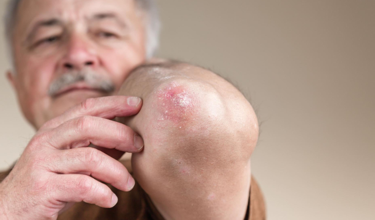 No SUS: Portaria inclui farmacêuticos  no cuidado à hanseníase