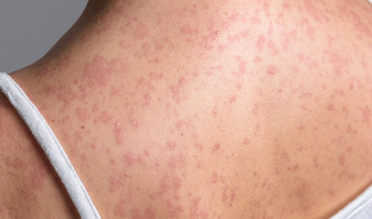 Nova York decreta emergência por surto de sarampo e amplia vacinação