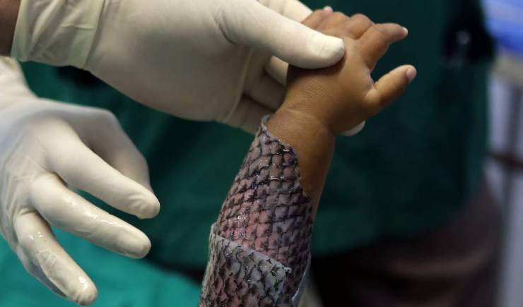 Brasil terá primeira fábrica de pele de tilápia para tratamento de queimaduras