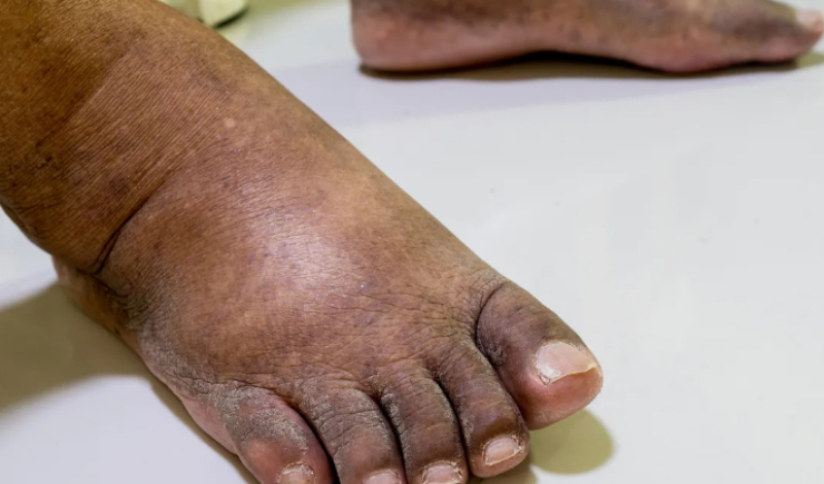 Ozonioterapia avança no Brasil e ganha respaldo inédito da Anvisa para tratamento de feridas