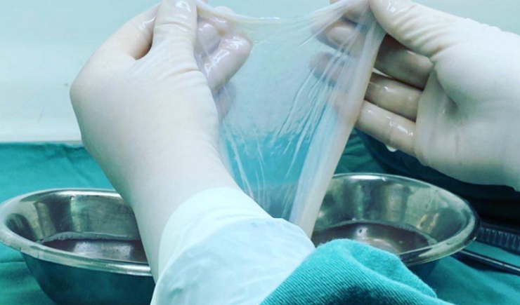SUS ofertará terapia com transplante da membrana amniótica no tratamento de queimaduras