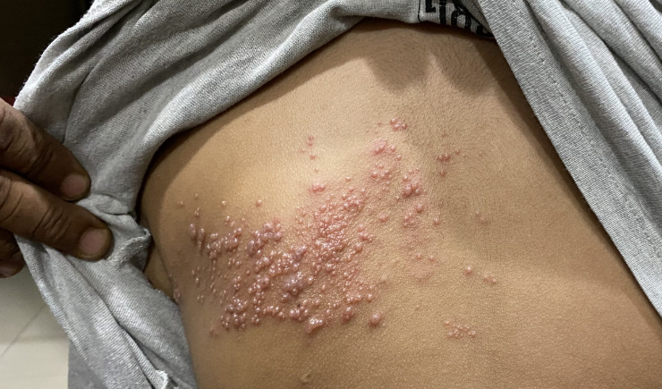 Ministério da Saúde mantém vacina contra herpes-zóster fora do SUS