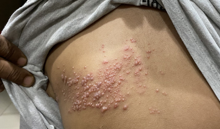 Ministério da Saúde mantém vacina contra herpes-zóster fora do SUS